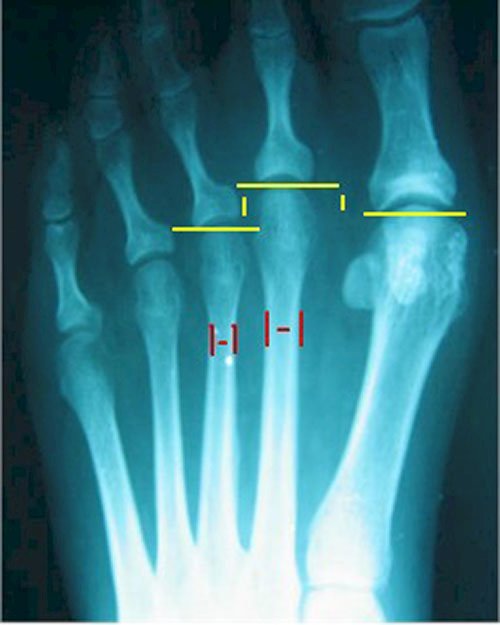 X-ray of the foot with metatarsal deformity